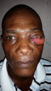 Infection in left eye